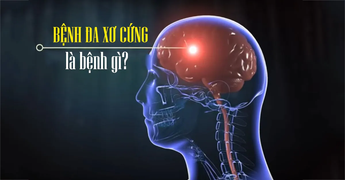 Bệnh đa xơ cứng là gì? Nguyên nhân và cách chữa trị hiệu quả