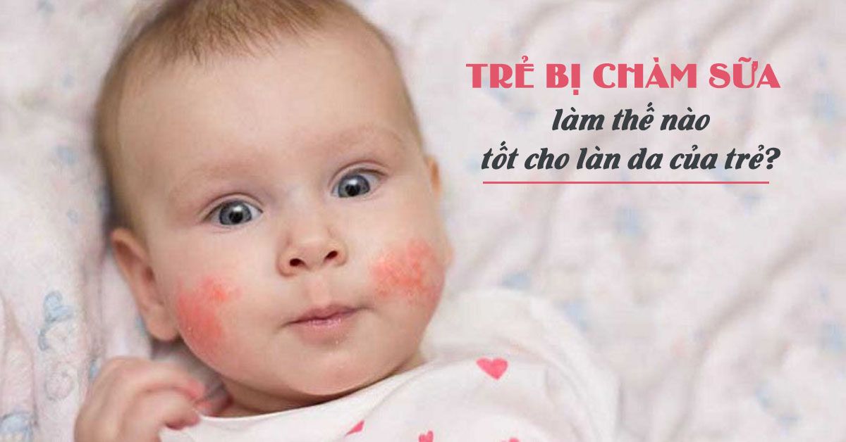 Bé bị chàm sữa nên điều trị hay để bệnh tự khỏi?