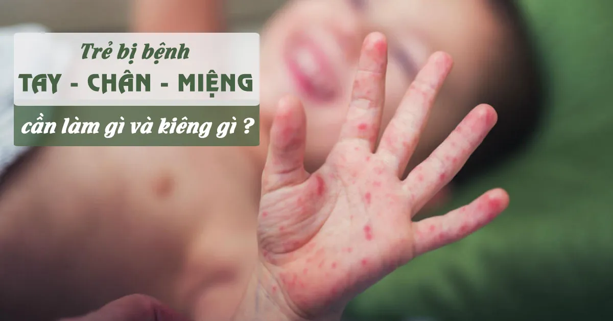 Trẻ bị bệnh tay chân miệng cần làm gì, kiêng gì?