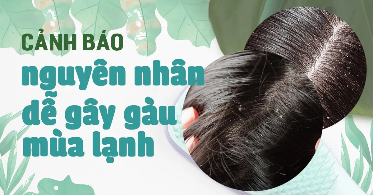 ‘Cảnh giác’ với 6 nguyên nhân khiến da đầu trắng gàu