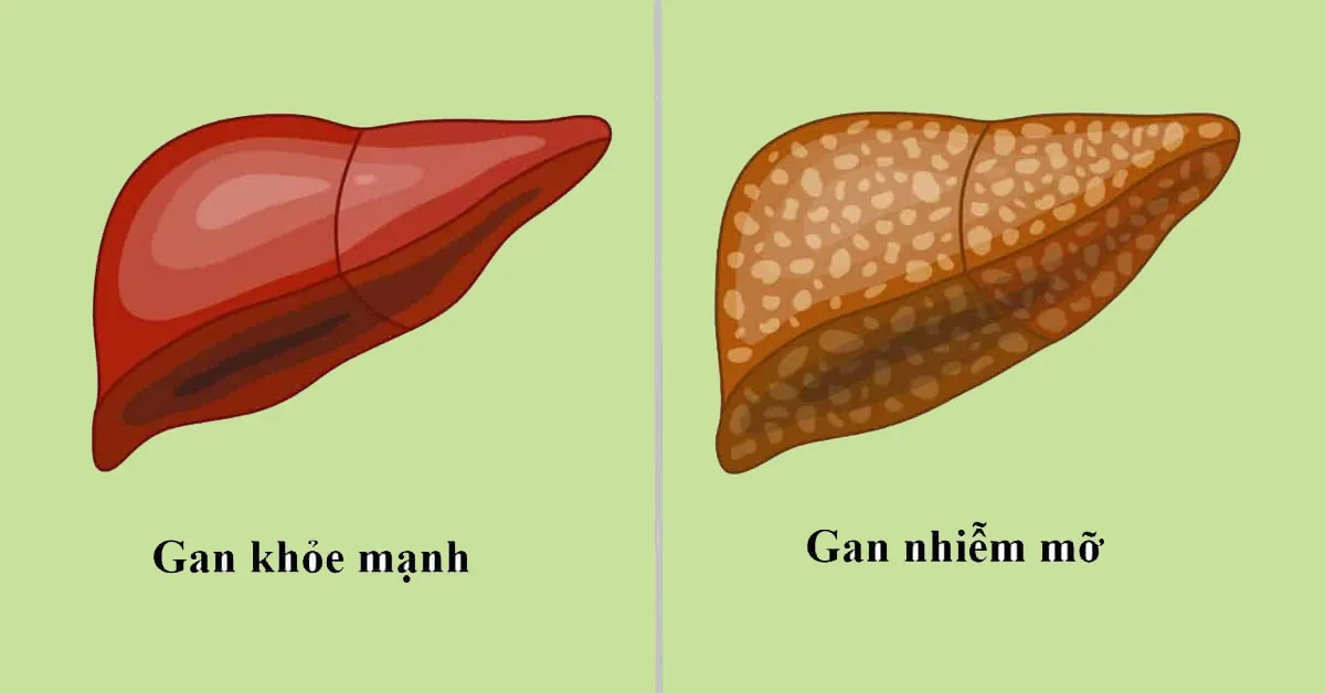 Gan nhiễm mỡ nhẹ có cần điều trị không?