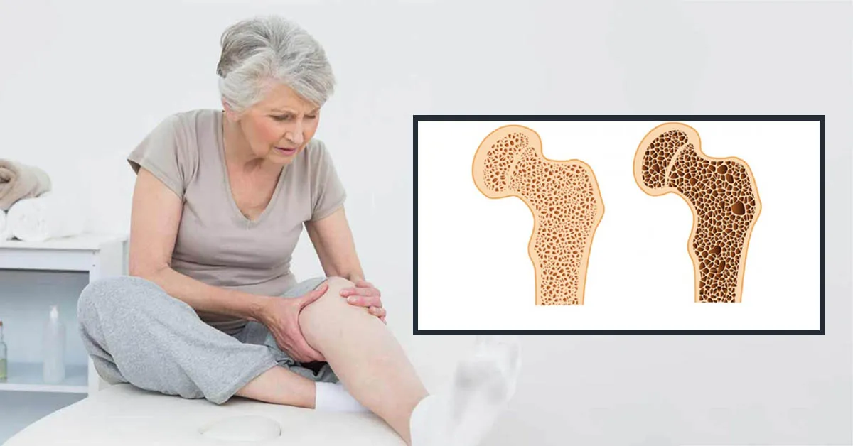 Thiếu xương phải làm sao?