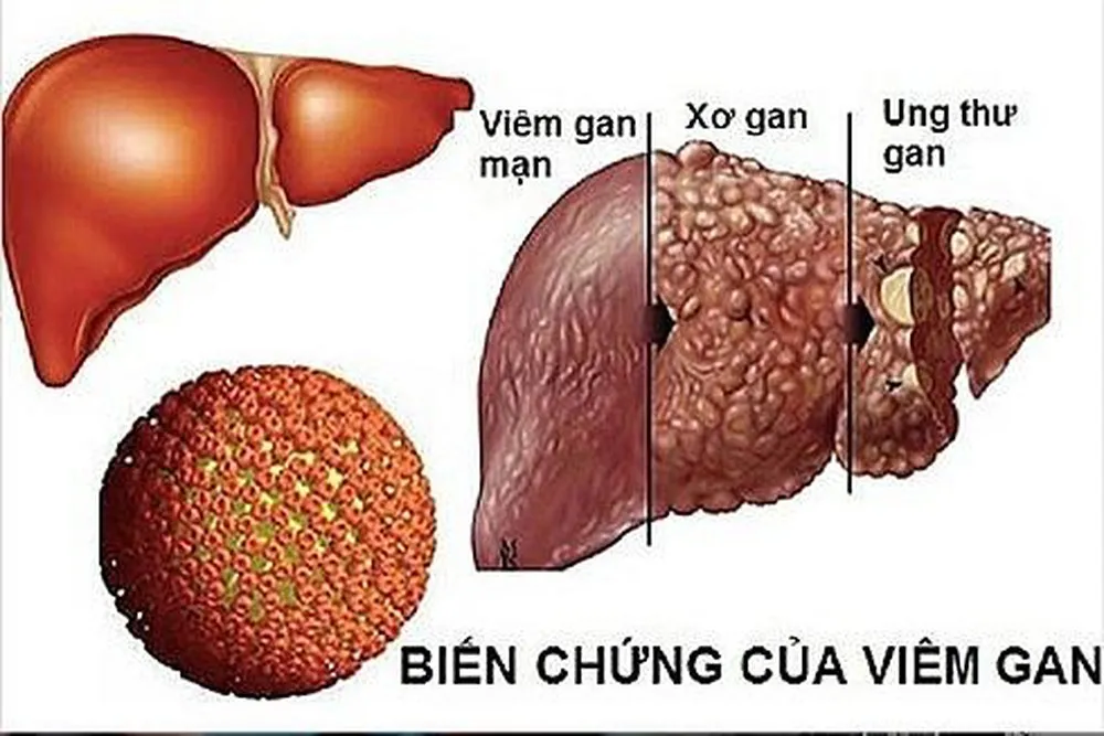 Người nhiễm viêm gan siêu vi B, C mạn tính, xơ gan dễ mắc ung thư gan