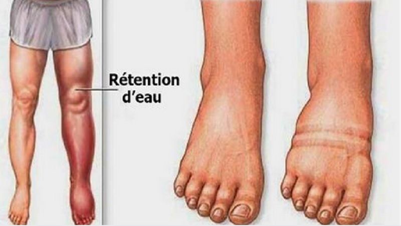 Thực phẩm và đồ uống hữu ích để ngăn tình trạng giữ nước