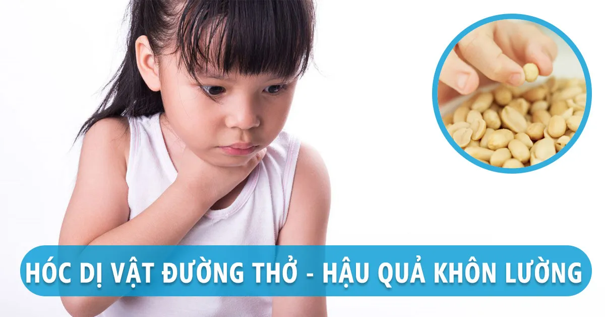 Hóc dị vật và 3 sai lầm thường gặp khi sơ cứu trẻ