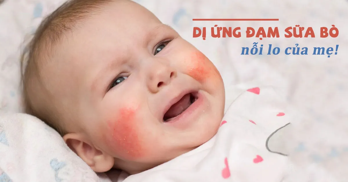Dấu hiệu nhận biết trẻ bị dị ứng đạm sữa bò và cách điều trị