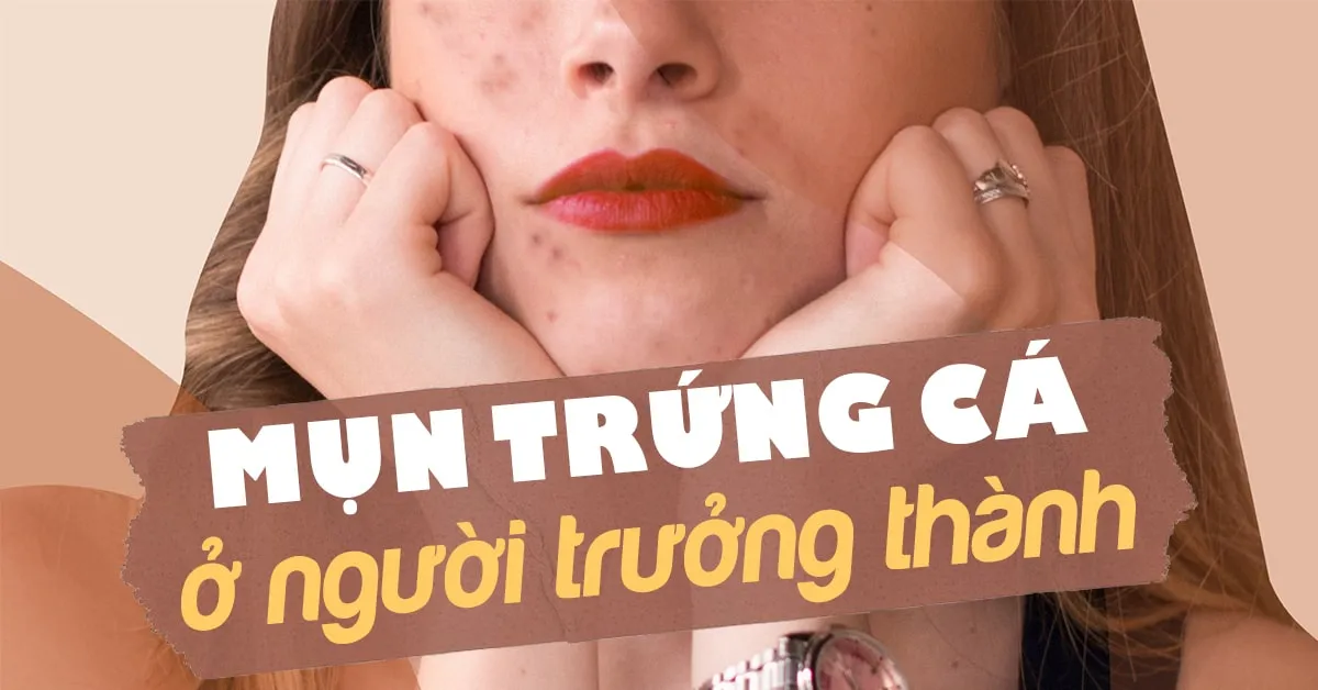 Vì sao người trưởng thành vẫn bị mụn trứng cá?