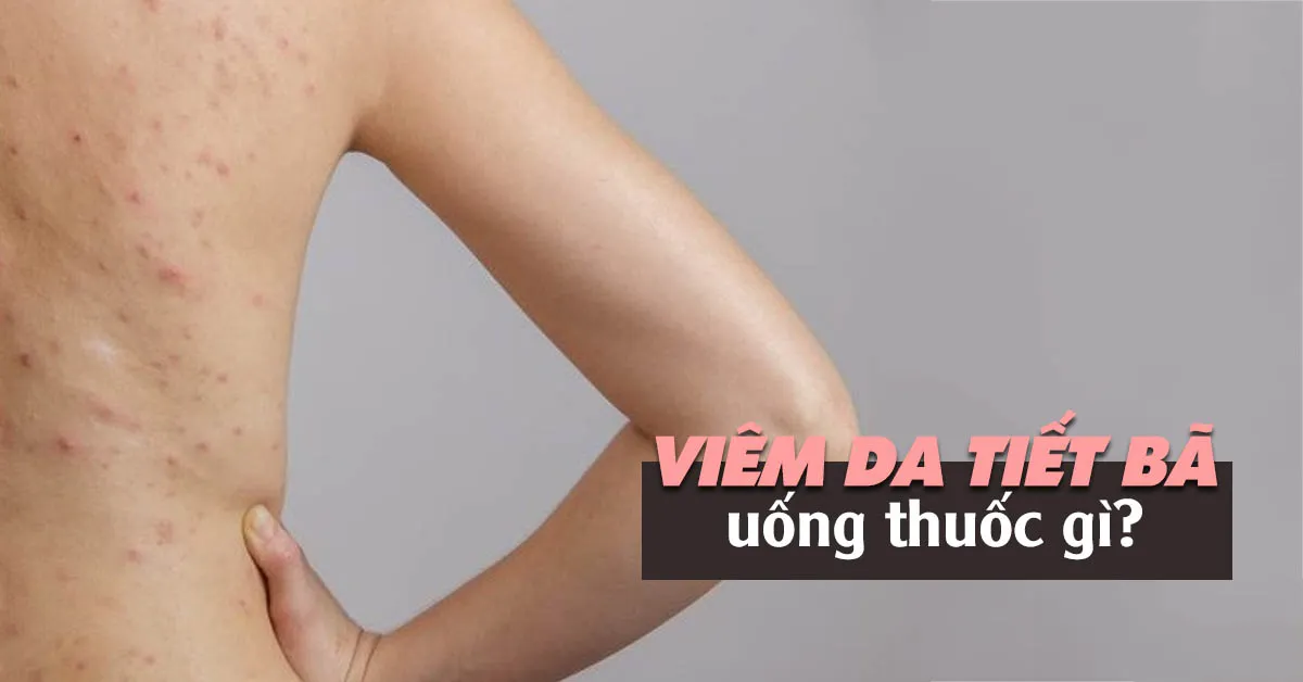 Chữa viêm da tiết bã bằng thuốc gì hiệu quả?