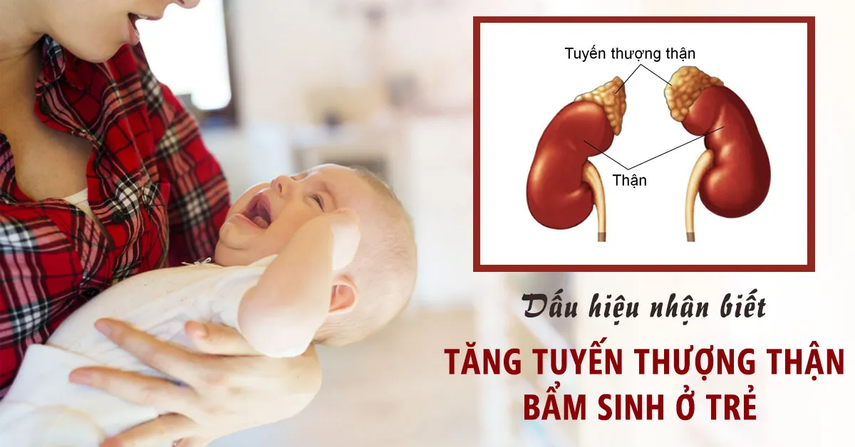 Tăng sản tuyến thượng thận bẩm sinh: Dấu hiệu nhận biết và cách điều trị
