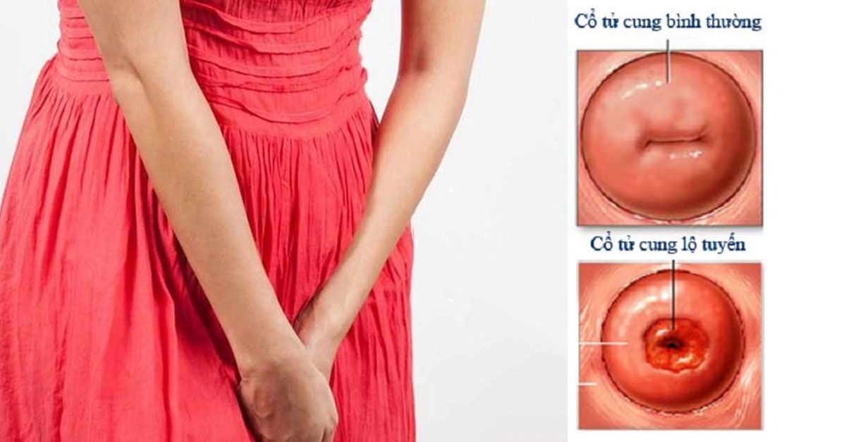 Lộ tuyến cổ tử cung là gì? Những dấu hiệu nhận biết điển hình