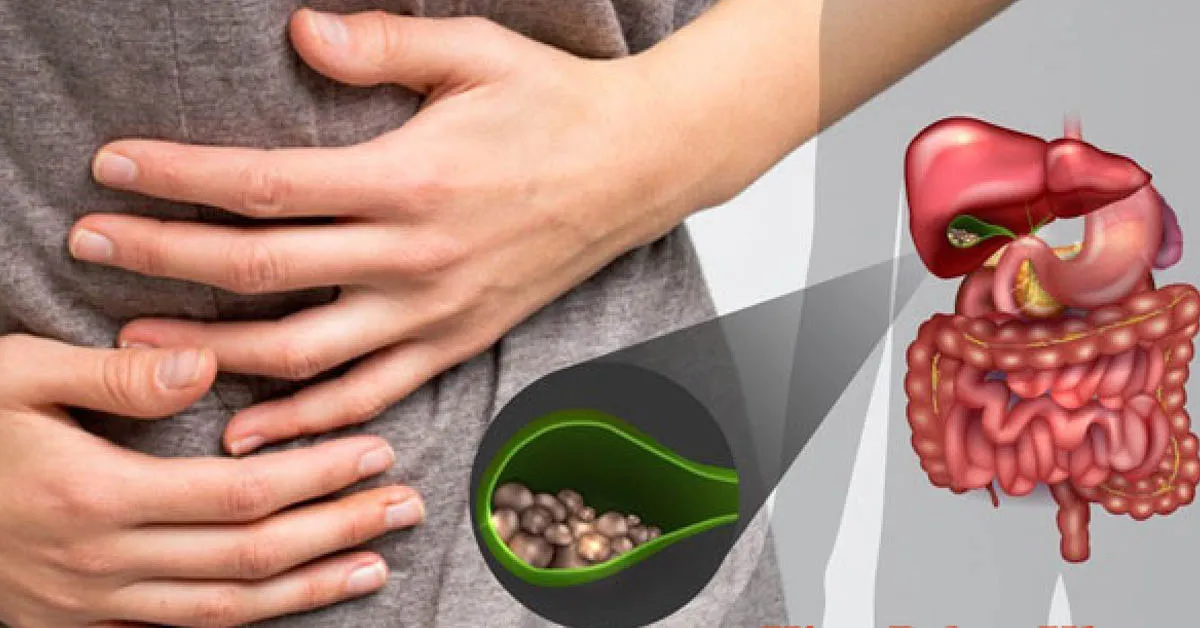 Cách làm giảm kích thước sỏi mật tại nhà