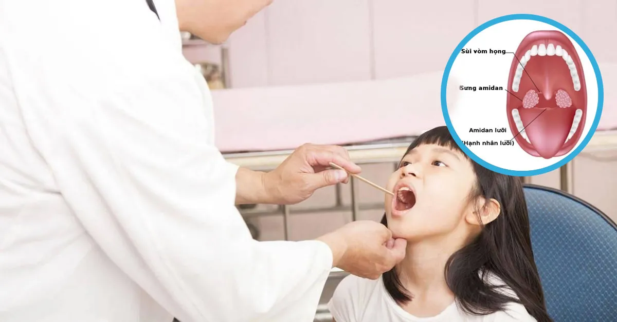 Khi nào nên cắt amidan cho trẻ?