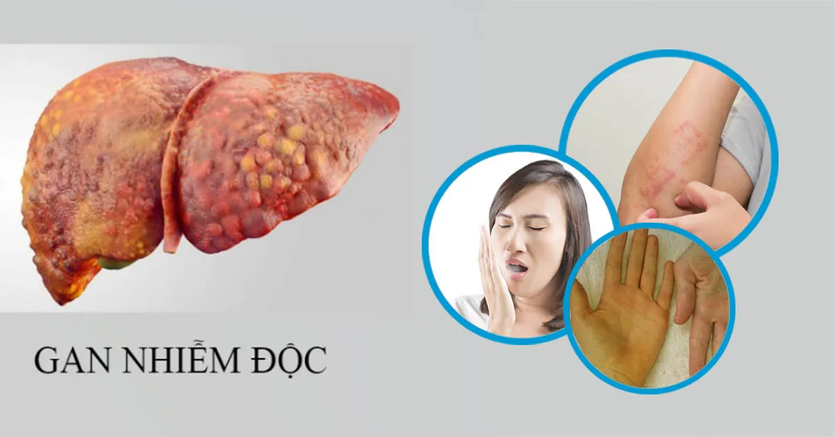 Gan nhiễm độc: nguyên nhân và dấu hiệu nhận biết