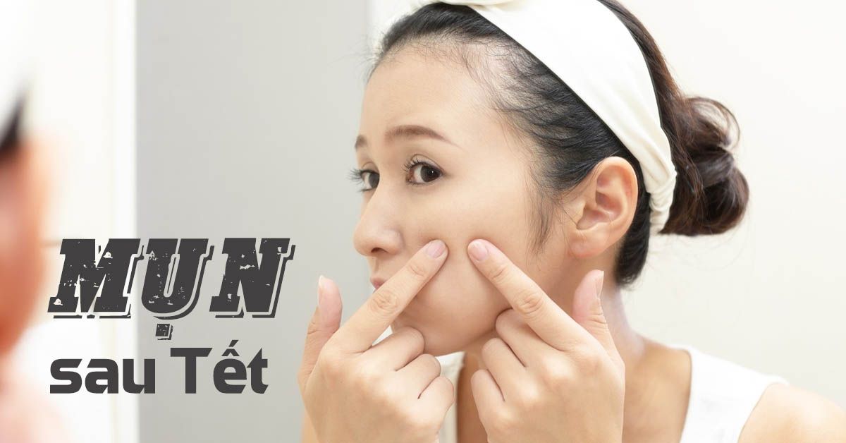 Bác sĩ chia sẻ bí quyết trị mụn sau Tết