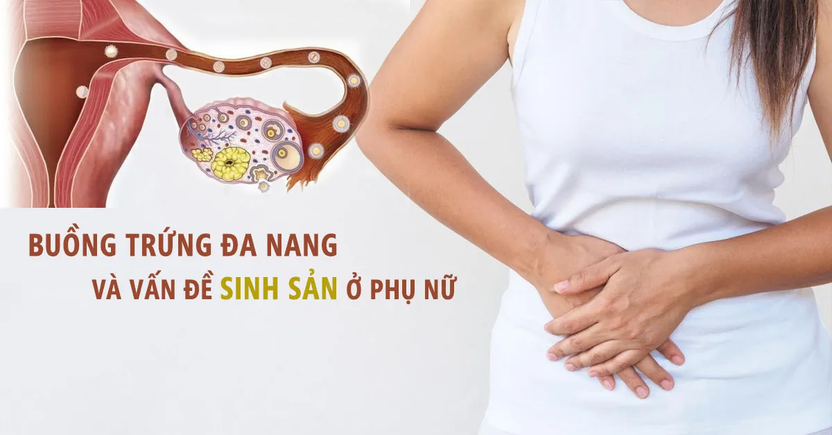 Buồng trứng đa nang - nguy cơ gây hiếm muộn ở phụ nữ