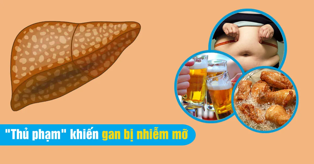 Gan nhiễm mỡ và những điều nên biết