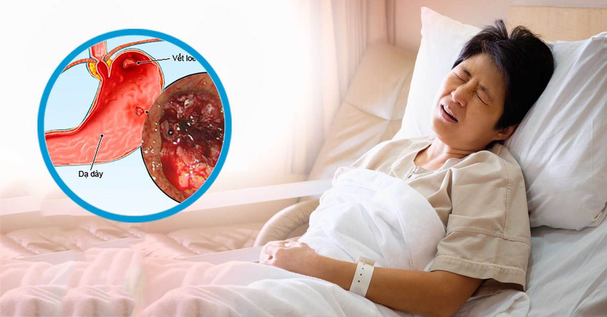 Hội chứng zollinger-ellison là gì?