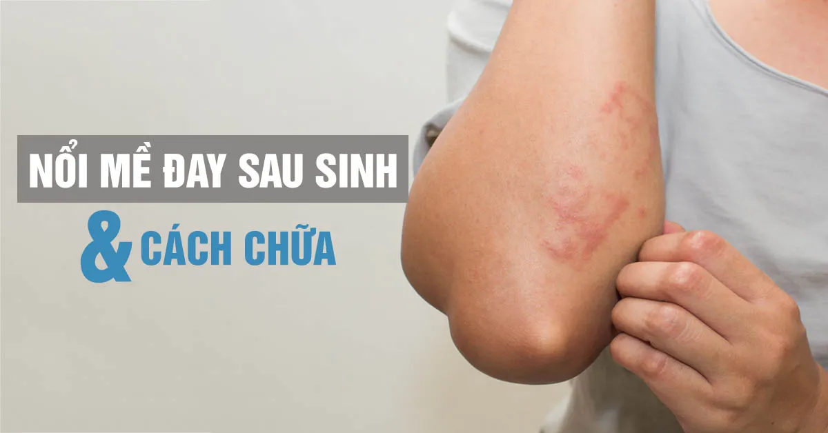 Nổi mề đay sau sinh điều trị bằng cách nào?