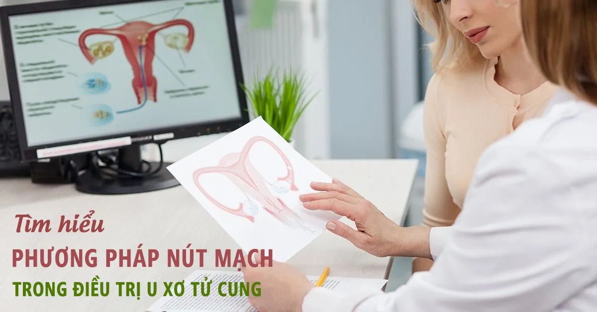 Bạn biết gì về phương pháp nút mạch trong điều trị u xơ tử cung?