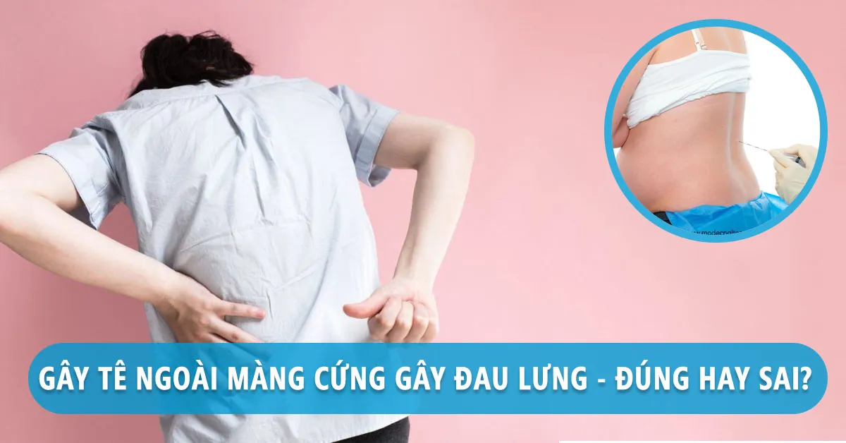 Phương pháp gây tê ngoài màng cứng có dẫn đến đau lưng sau sinh?