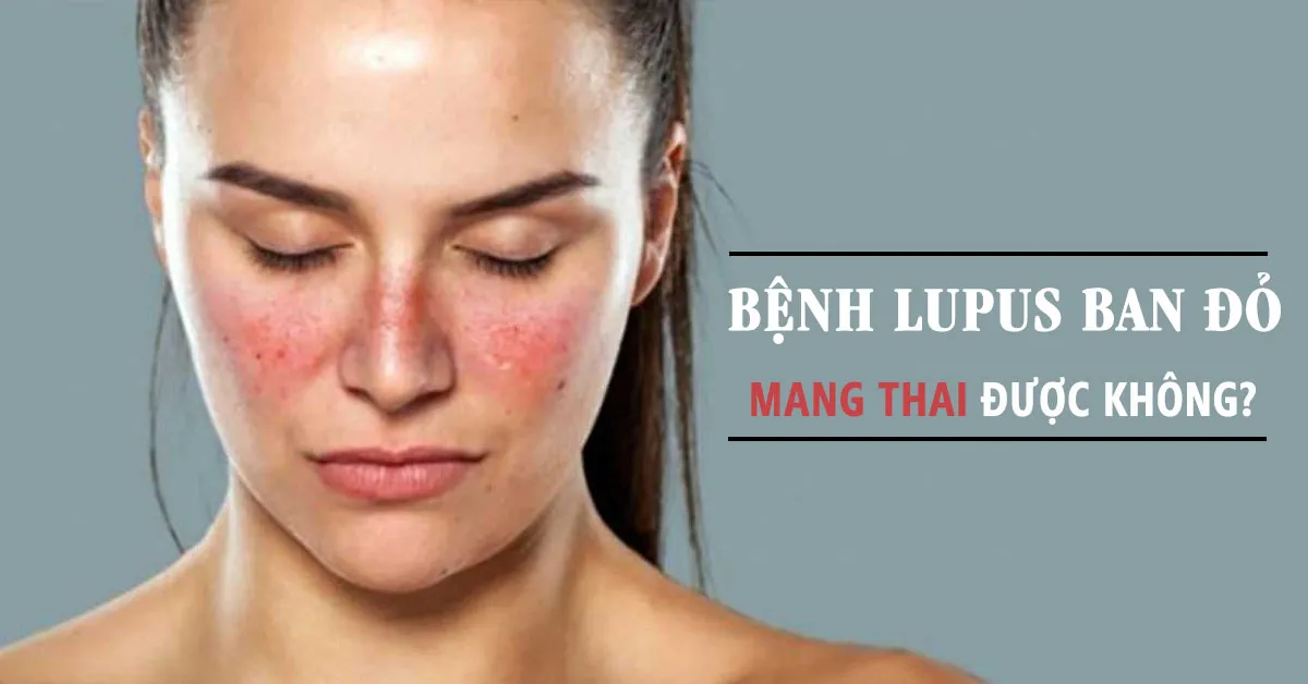 Phụ nữ bị bệnh lupus ban đỏ có nên mang thai?