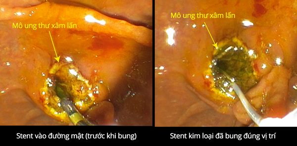 Kỹ thuật nội soi mật tụy ngược dòng giúp giải áp đường mật cho bệnh nhân ung thư cao tuổi