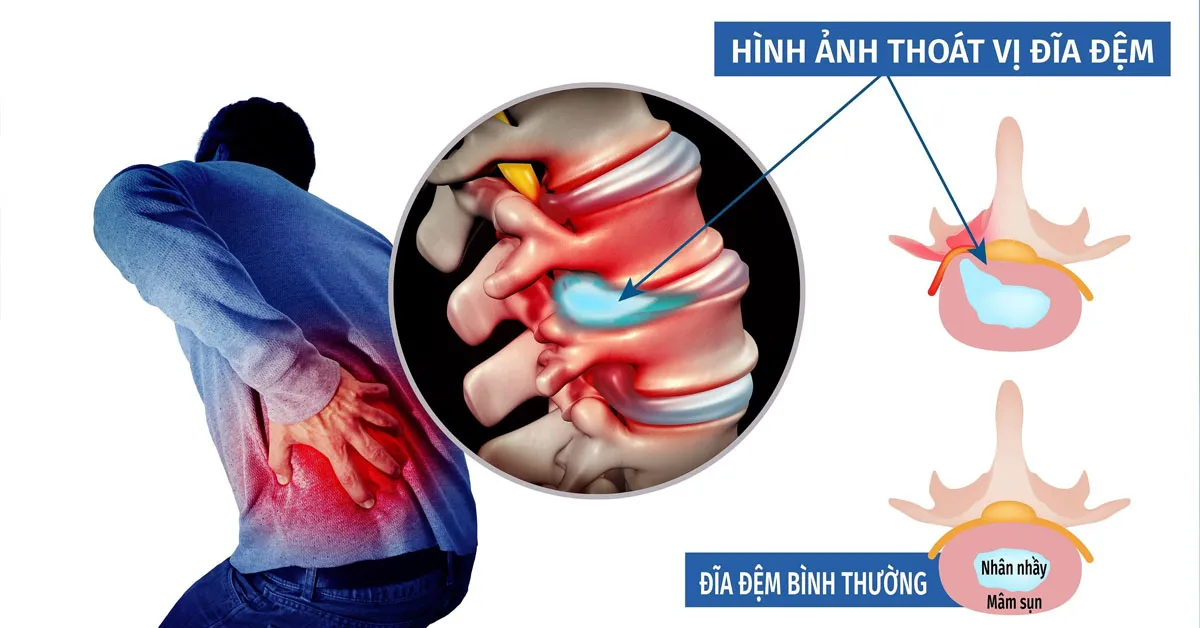 Thoát vị đĩa đệm hiểu sao cho đúng?