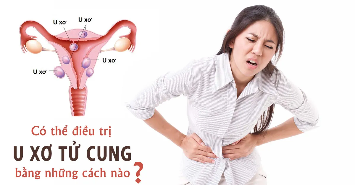 4 phương pháp điều trị u xơ tử cung cần biết