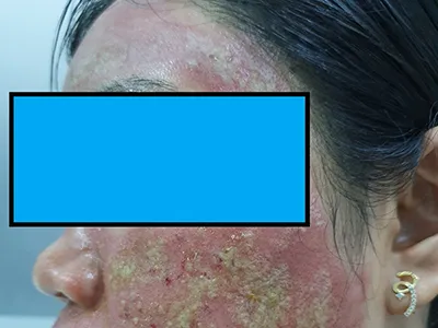 Tổn thương nghiêm trọng do tai biến lăn kim tại spa
