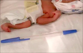 Bé gái sinh non có chiều dài bằng cây bút đã sống sót kỳ diệu