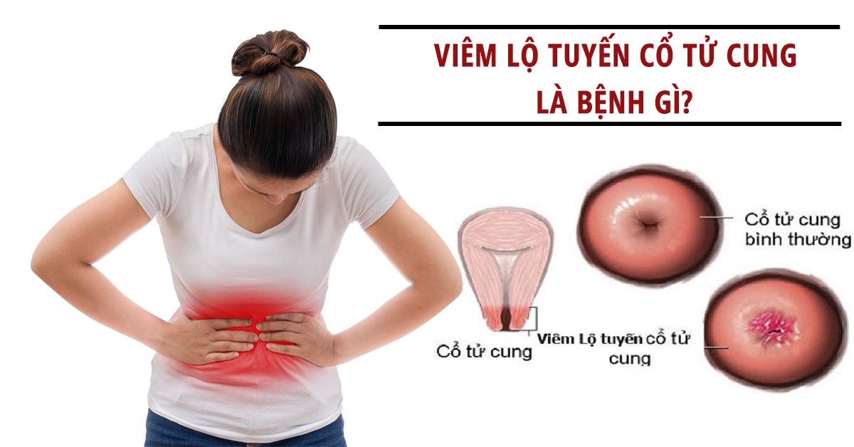 3 dấu hiệu giúp nhận biết viêm lộ tuyến cổ tử cung và cách điều trị
