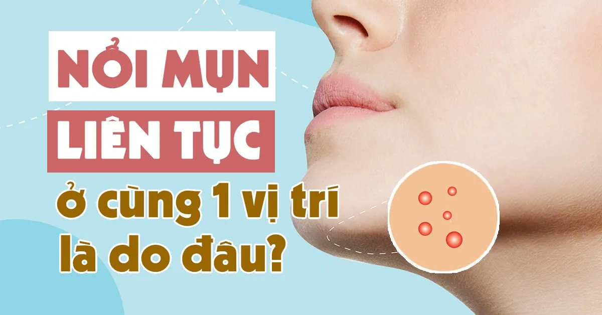 Tại sao bạn bị nổi mụn liên tục ở cùng một vị trí?