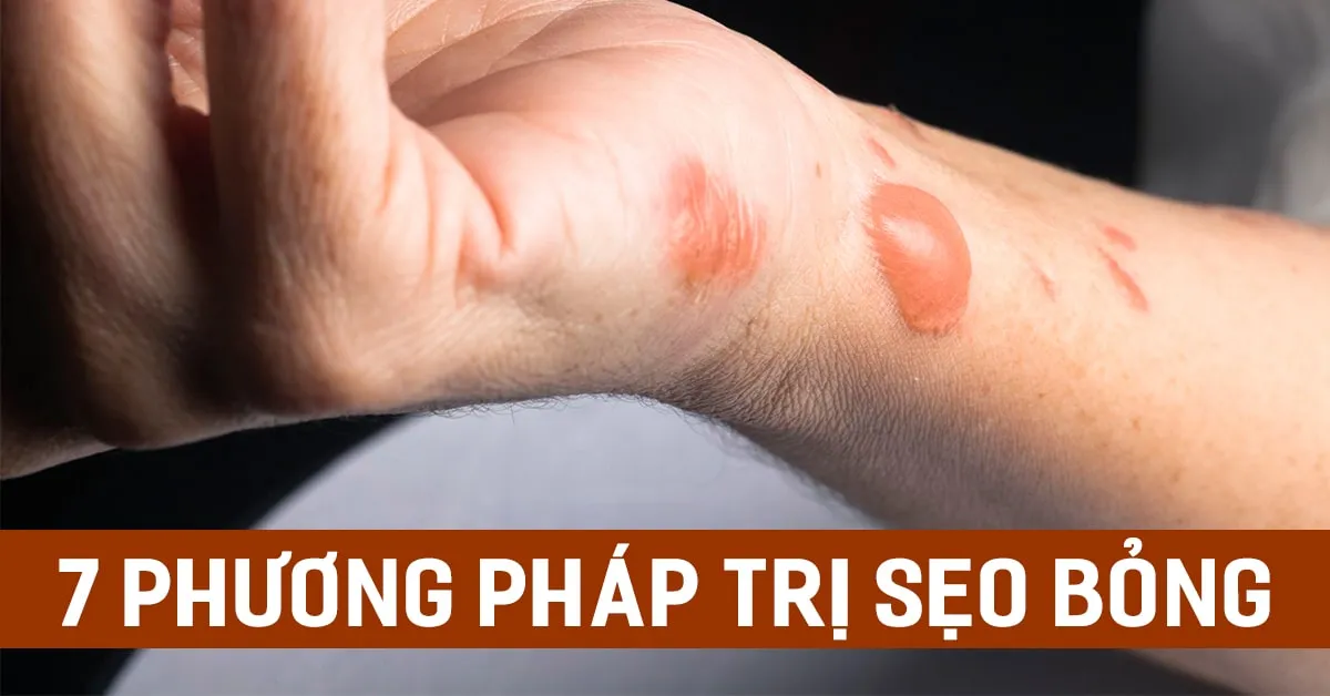 7 phương pháp đặc trị sẹo bỏng mới lẫn sẹo bỏng lâu năm mà bạn nên biết