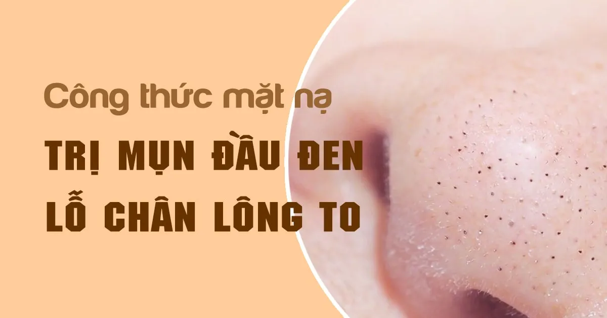 5 công thức trị mụn đầu đen và lỗ chân lông to giúp da láng mịn, trắng hồng