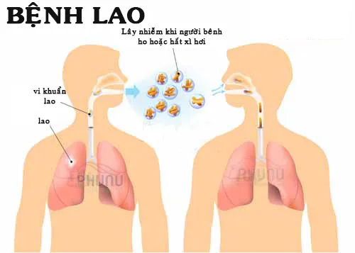 Truyền thông nâng cao ý thức phòng, chống bệnh lao