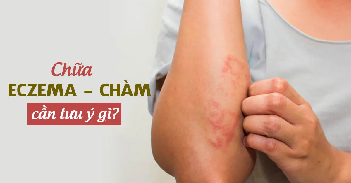 Chữa Eczema (chàm) cần lưu ý điều gì để tránh bội nhiễm?