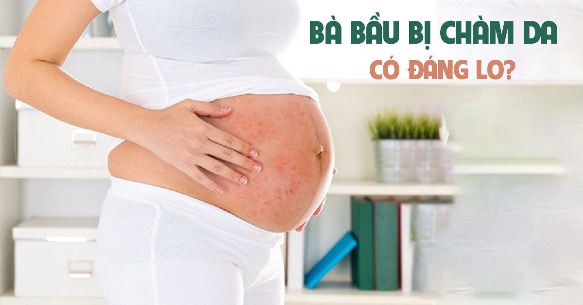 Bị chàm khi mang thai có sao không?