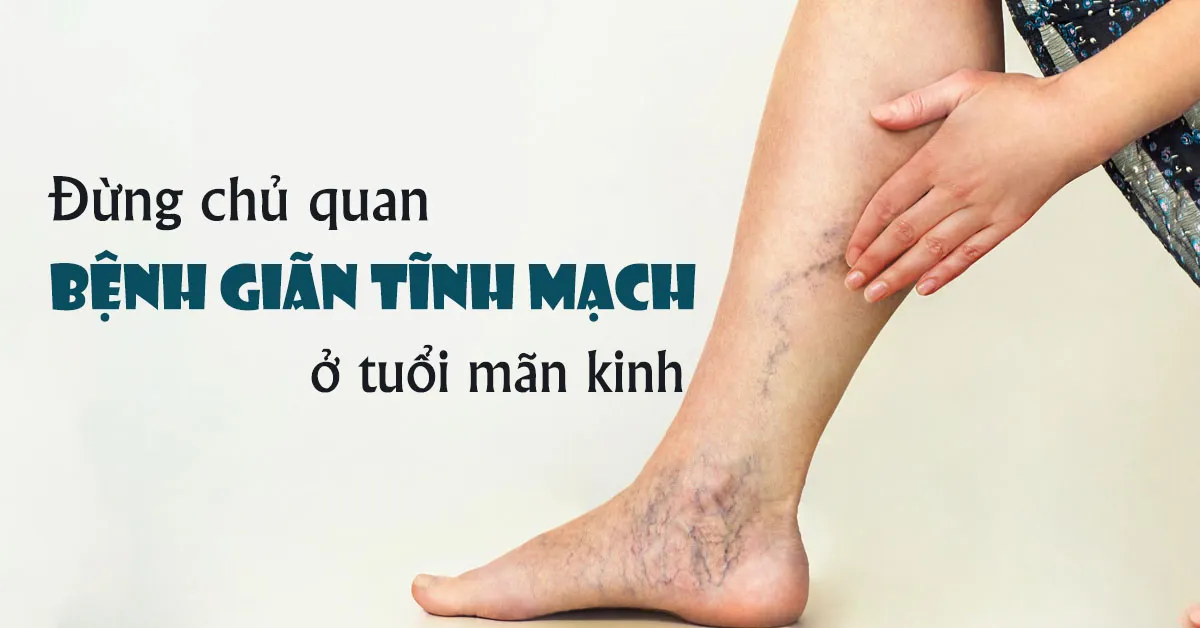 Giãn tĩnh mạch ở tuổi mãn kinh là bệnh gì, có nguy hiểm không?