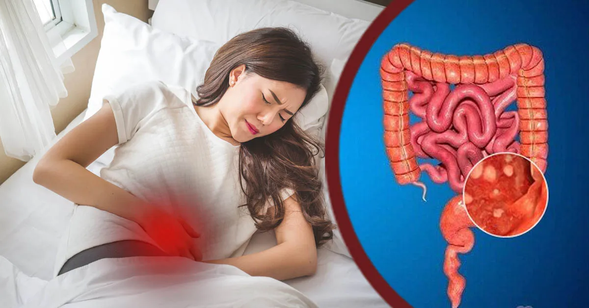 Viêm đại tràng mãn tính là gì? Hiểu rõ để tránh 4 biến chứng nguy kịch sau