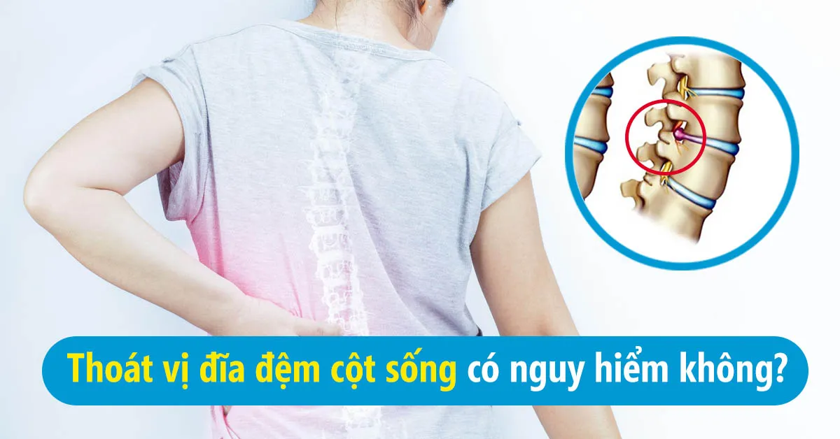 Thoát vị đĩa đệm cột sống: dấu hiệu nhận biết và cách điều trị
