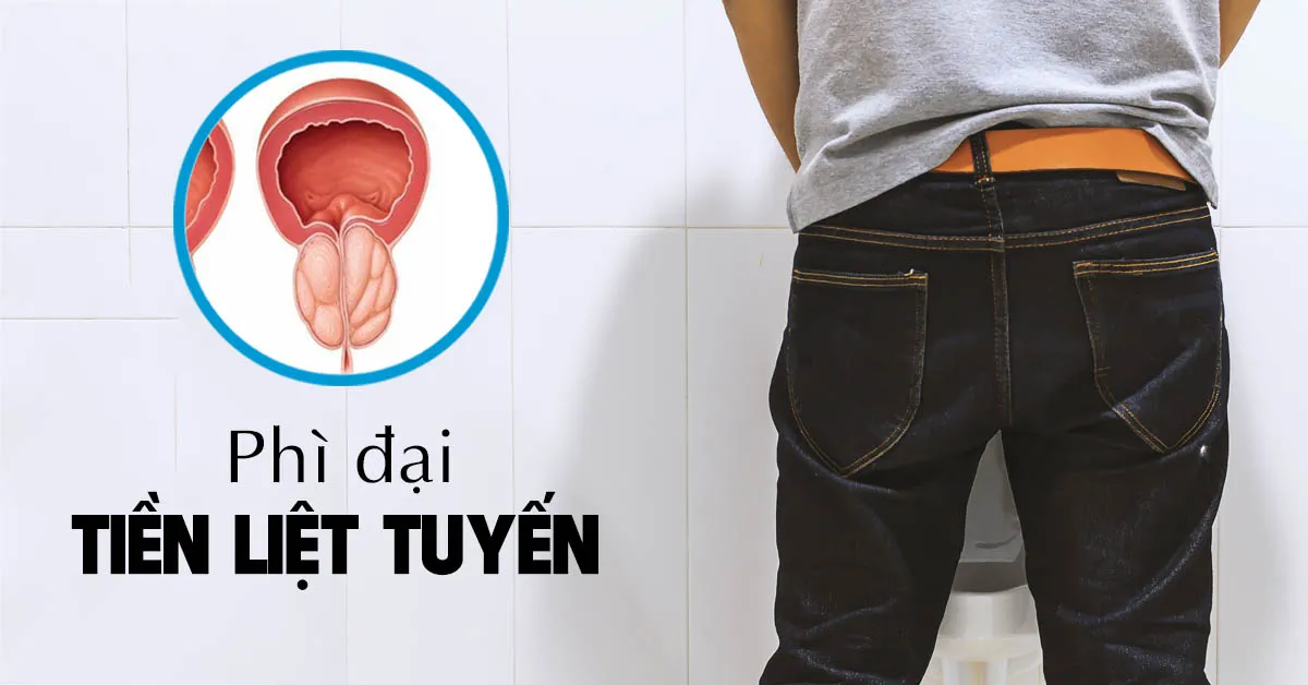 Phì đại tiền liệt tuyến và những điều nam giới nên biết