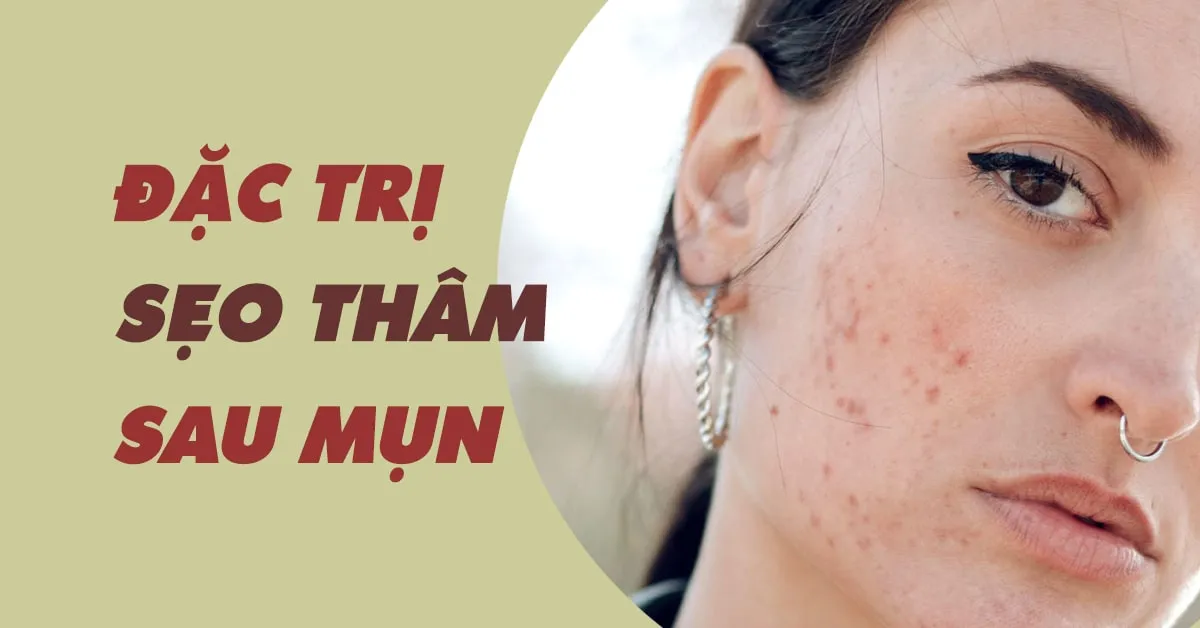 Trị sẹo thâm sau mụn như thế nào để lấy lại làn da sáng mịn?