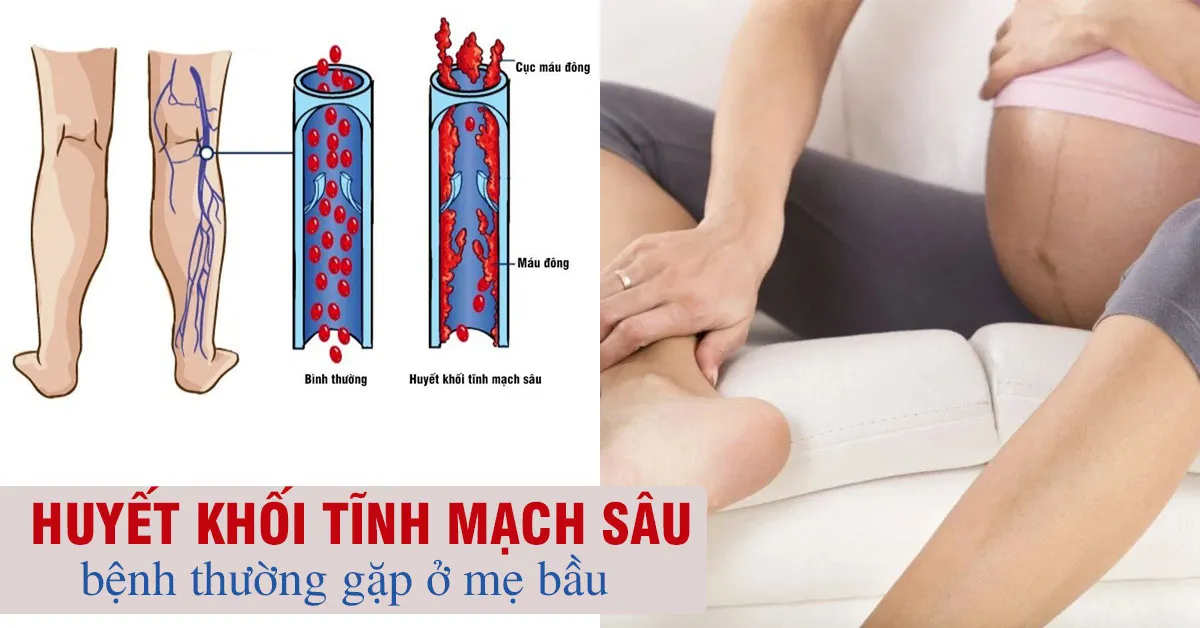 Bệnh huyết khối tĩnh mạch sâu và điều phụ nữ mang thai cần biết