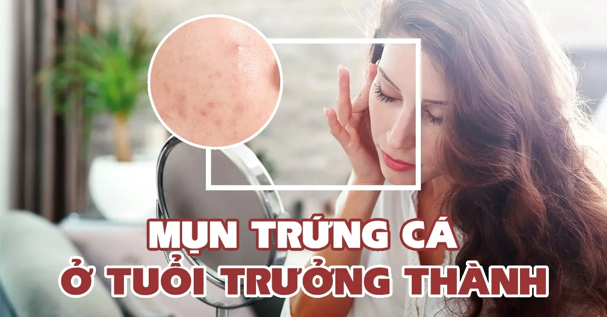 5 điều bạn cần biết về mụn trứng cá ở người trưởng thành