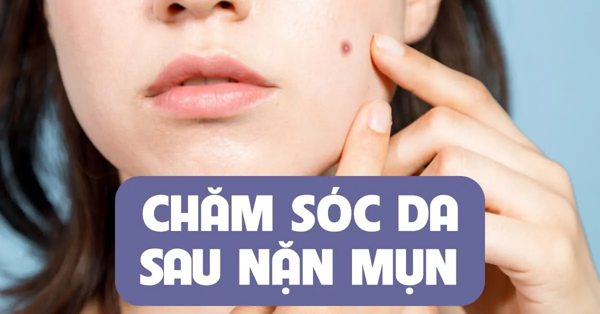 7 nguyên tắc chăm sóc da sau nặn mụn giúp bạn ‘né nhanh’ thâm sẹo