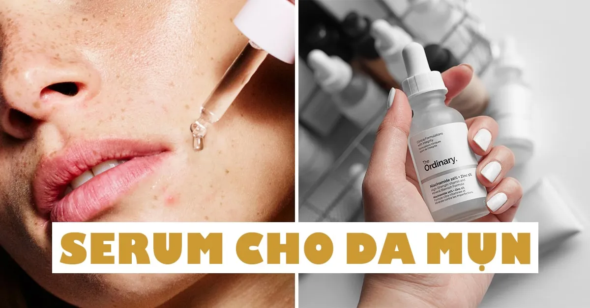 5 lọ serum cho da mụn vừa nhẹ dịu vừa trị mụn, phục hồi da cực xịn