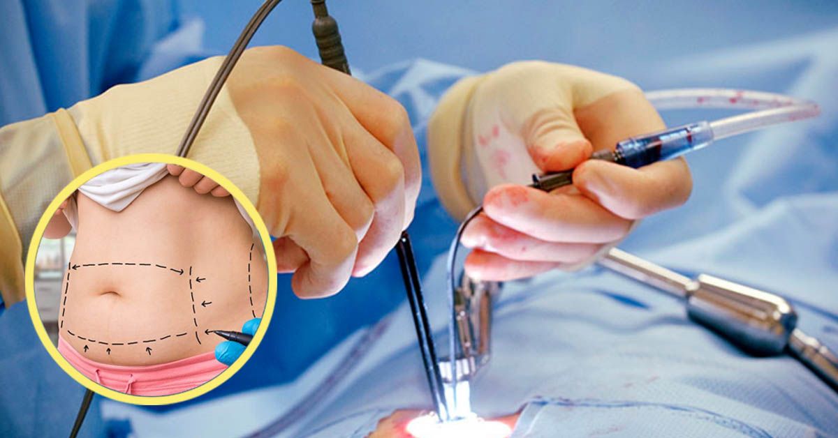 Hút mỡ có thật sự nguy hiểm không?