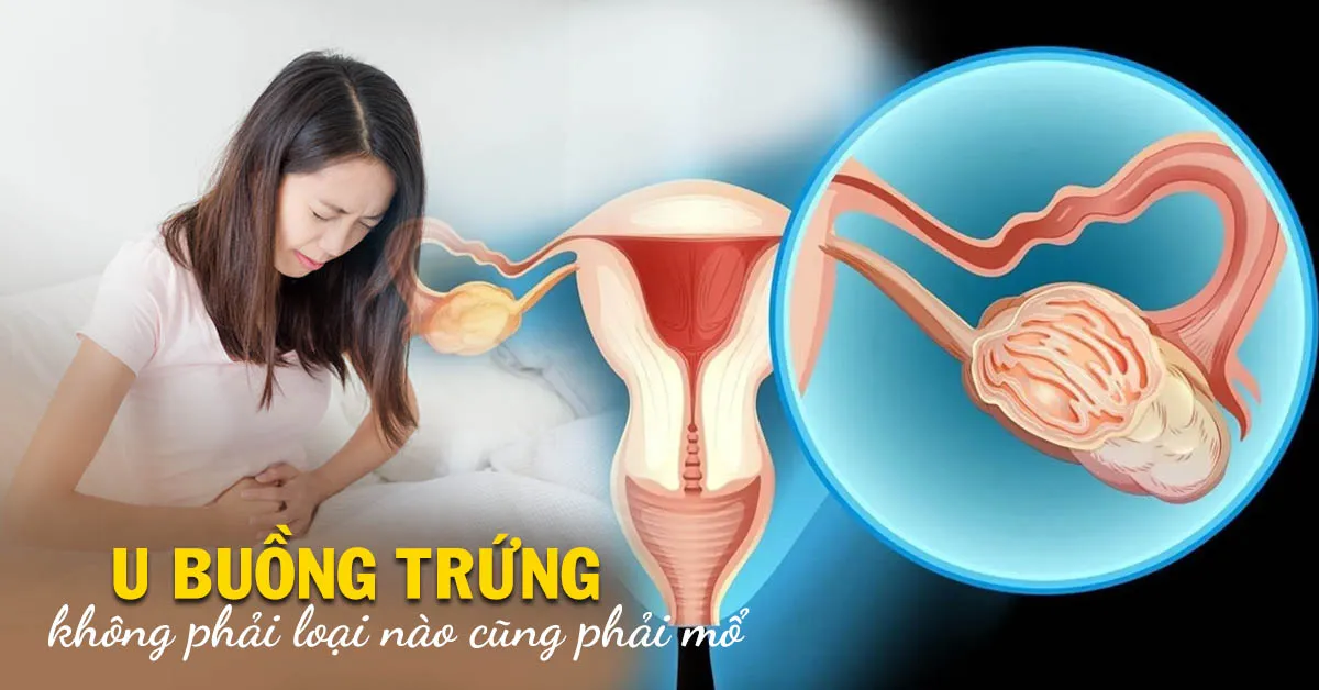 Các loại u buồng trứng: loại nào không cần điều trị, loại nào cần phải mổ?