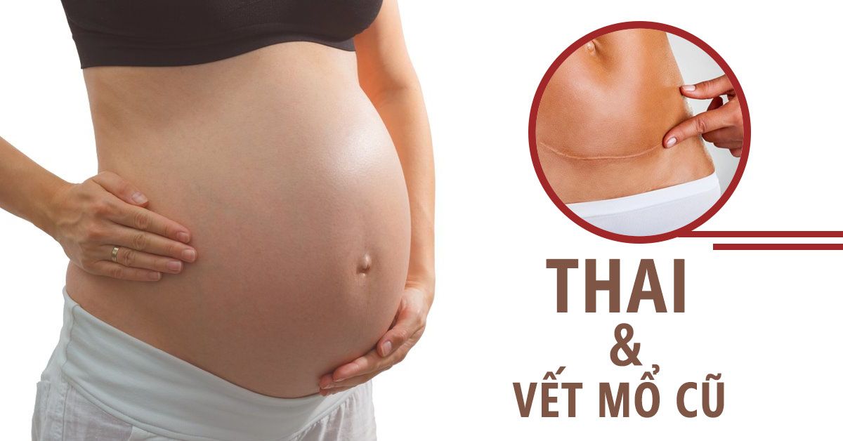Những vấn đề có thể bạn chưa biết về vết mổ lấy thai cũ