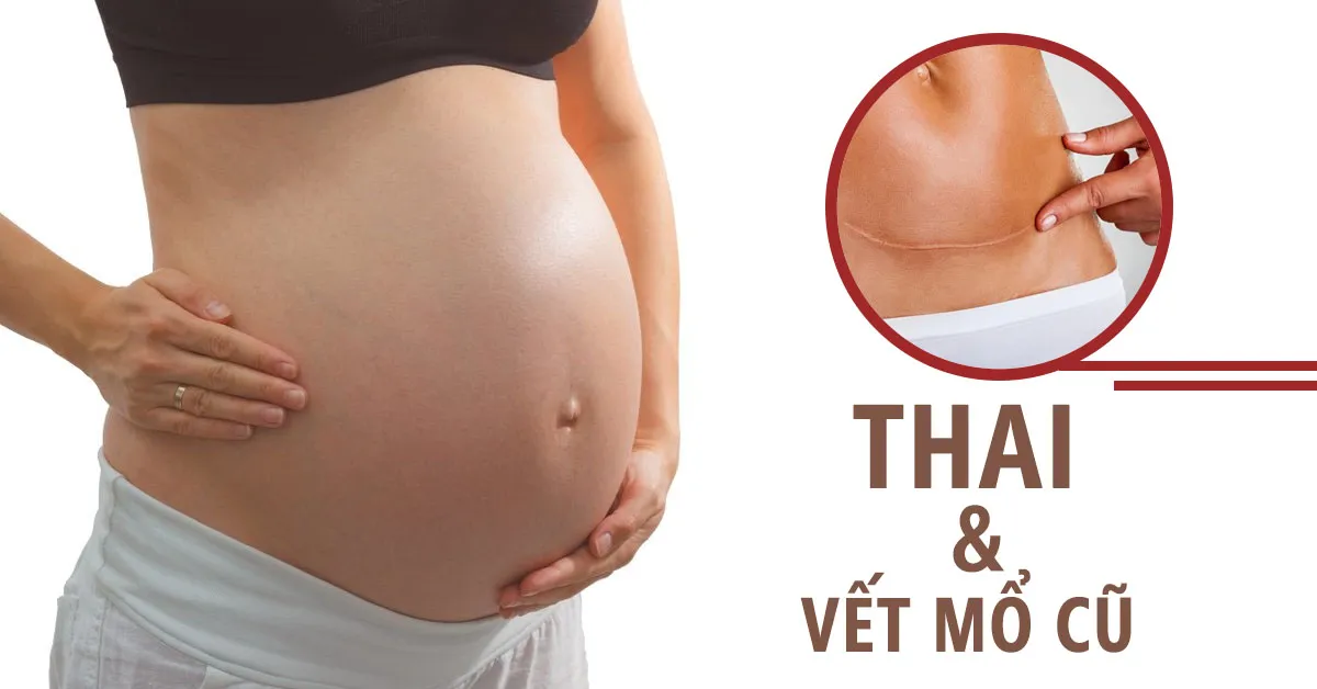Những vấn đề có thể bạn chưa biết về vết mổ lấy thai cũ